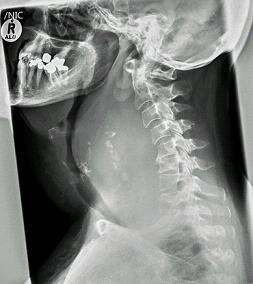 BMJ：钝性颈部创伤后亚急性气道急症处理-案例报道