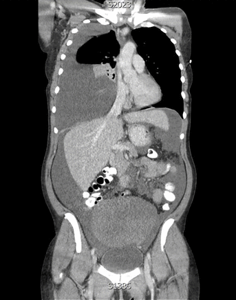BMJ：这个患者为啥呼吸困难和腹部肿胀-案例报道