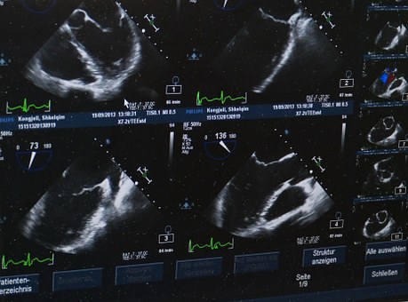Circ Cardiovasc Imaging：经<font color="red">胸</font>三维超声心动图测量的右心室射血分数预后价值如何？