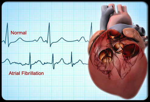 Heart：房颤患者临床表现与1年<font color="red">预后</font>的性别差异<font color="red">如何</font>？