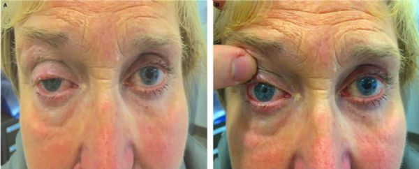 BMJ：双侧瞳孔不等和上睑下垂的特发性Horner氏综合征-案例报道