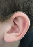 防控耳聋须从精准诊断入手