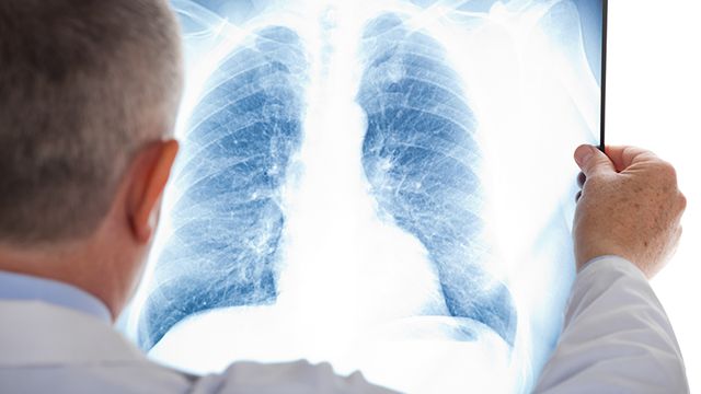 流行病学研究：维生素C、胡萝卜素等抗氧化剂可以降低肺癌风险