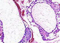 NAT MED：弥漫性内皮神经胶质瘤全新治疗靶点