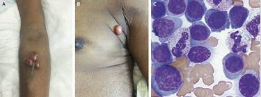 NEJM：浆细胞瘤和浆细胞白血病 -案例报道