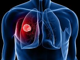 转移性肺癌：症状，诊断和治疗