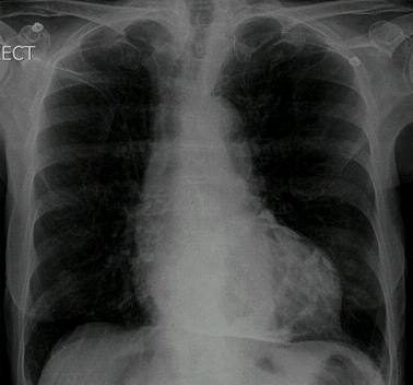 BMJ：呼吸困难和不寻常的胸片-案例报道