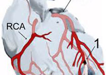 Heart：冠状动脉分叉病变是选择<font color="red">PS</font>还是TS?