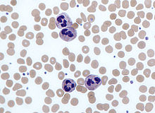CLIN CANCER RES：产IL-17的<font color="red">中性</font><font color="red">粒细胞</font>可加速胃癌进展