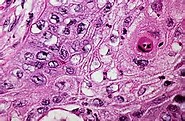 The Lancet Oncology：曲妥珠单抗不能提高HER2阳性晚期胃癌患者的生存率
