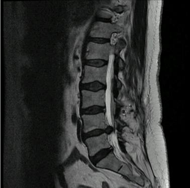 BMJ：女性下腰痛-案例报道