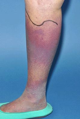 下肢蜂窝织炎图片