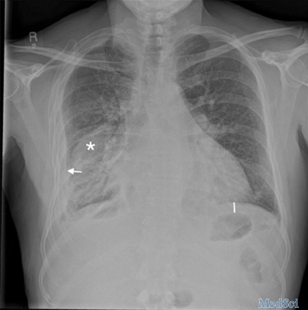 BMJ：易被误诊的胸腔积液-案例报道