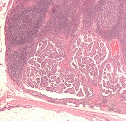 SCI REP：甲状腺乳头状癌超声弹性成像与病理特征之间的联系