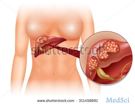 J Gastroenterol：乐伐<font color="red">替</font><font color="red">尼</font>晚期肝细胞癌2期临床研究