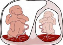 Obstet Gynecol：死胎孕妇分娩方式的选择？