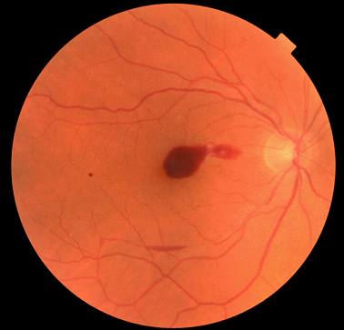 BMJ：继发于西地那非治疗后的视网膜静脉阻塞 -案例报道