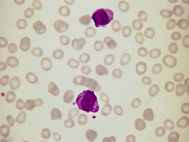 BMJ：<font color="red">淤斑</font>和异常白细胞-案例报道