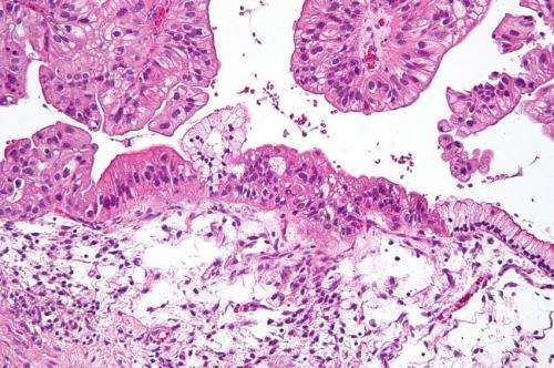 Nat Genet：大规模研究发现可能增加卵巢癌风险的新变异