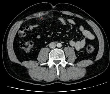 BMJ：肠脂垂炎-案例报道