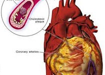 CIRC RES：冠心病患者7-酮基胆固醇与心血管预后和总死亡相关！