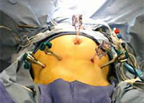 Obstet Gynecol：<font color="red">腹腔</font>镜与开腹手术在新辅助化疗后的卵巢癌减瘤术中的比较！