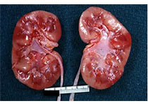 KIDNEY INT：过表达B型钠尿肽可以减轻多囊肾病大鼠的肝肾纤维<font color="red">囊</font>性疾病！