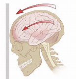 Neurology：血清神经丝蛋白是高敏感的<font color="red">脑震荡</font>生物标记物