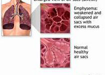 Heart：伴有CVD高风险的COPD患者采用吸入<font color="red">性</font>β2-<font color="red">受体</font>激动<font color="red">剂</font>和<font color="red">糖皮质激素</font>治疗的心血管结局如何？