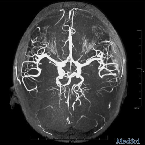 病例分析：以晕厥为首发表现的脑栓塞 病因很罕见
