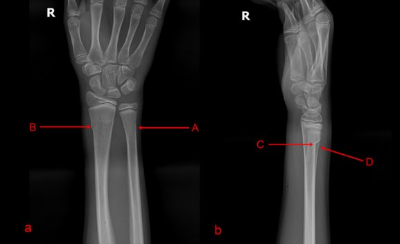 右手腕尺骨茎突图片图片