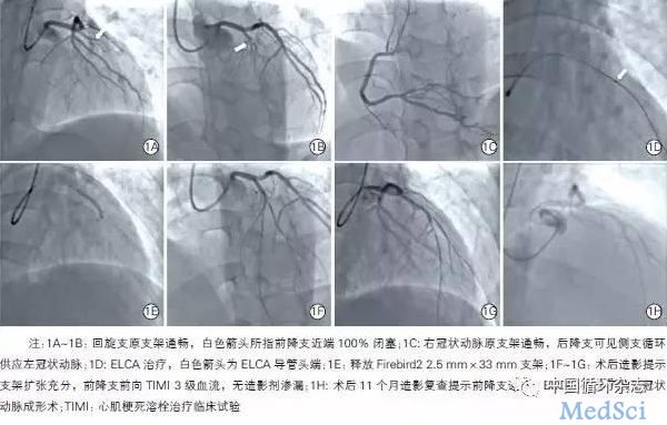 中国循环杂志：新技术治疗闭塞病变，准分子激光可消蚀机化血栓、结缔组织和钙化