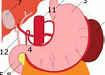 Ann Surg：腹腔镜<font color="red">术后</font>发生胃食管反流的<font color="red">结果</font>