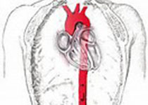Heart：CABG中采用<font color="red">双边</font>或单侧乳内动脉移植一年内成本哪个高？