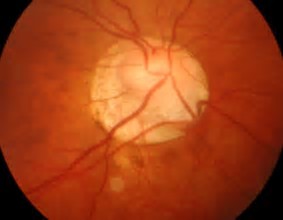 PNAS：眼压升高是造成青光眼早期过免疫反应的直接原因