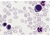 Leuk Lymphoma：体重指数可以预测<font color="red">弥漫性</font>大B<font color="red">细胞</font>淋巴瘤的结局吗？