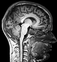 JAMA Neurol：老年人脑海绵状血管畸形流行病学研究