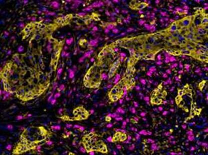 OncoImmunology：胰腺癌细胞附近的免疫细胞或可“助纣为虐”促进癌症扩散