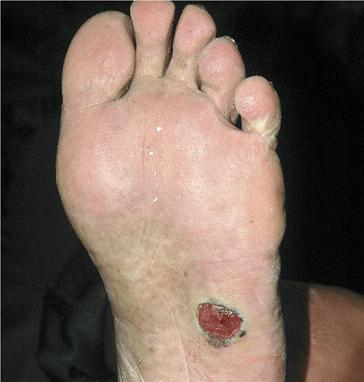 脚底黑色素瘤图片