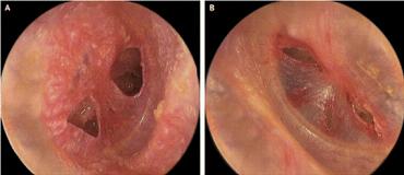 NEJM：爆震伤后双耳<font color="red">鼓膜</font><font color="red">穿孔</font>-案例报道