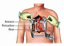 Eur <font color="red">Heart</font> J：心脏手术ACEF II风险评分！
