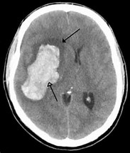 Neurology：新发短暂性脑缺血或轻微脑梗塞与7日后再损伤