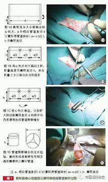 Chin Circul J：北京儿童医院李晓峰等独创复杂先心手术方式疗效好