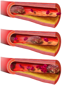 一种常见的<font color="red">脑血管</font>疾病竟与肠道微生物组存在关联