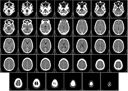 J Hypertens：高血压患者脑小血管病变MRI进展与认知功能下降有何关系？
