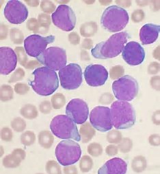 Nature Immunology：急性<font color="red">淋巴</font>白血病中STAT5激活程度与<font color="red">疾病</font>发展密切相关