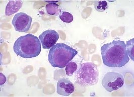 Blood：发现新一种人类白细胞抗原基因突变导致获得性再生障碍性贫血