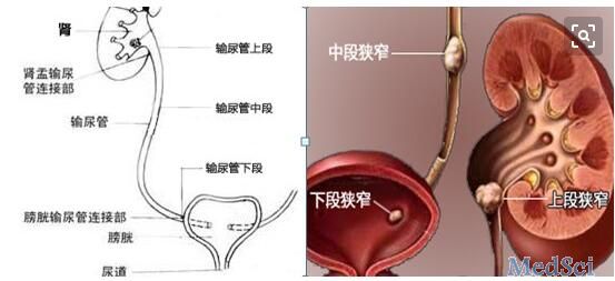 右侧输尿管<font color="red">上段</font>结石病例1例