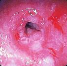 Gastroenterology：<font color="red">SLC</font>39A<font color="red">6</font>基因上调有助于食管鳞状细胞癌(ESCC)的诊断