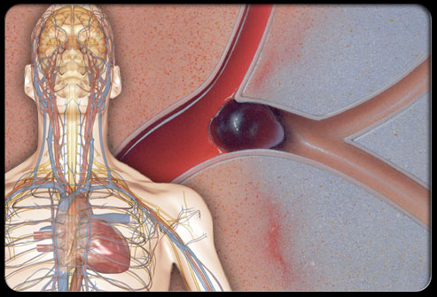 Stroke：血栓<font color="red">长度</font>对动脉内血栓抽吸结局的影响！